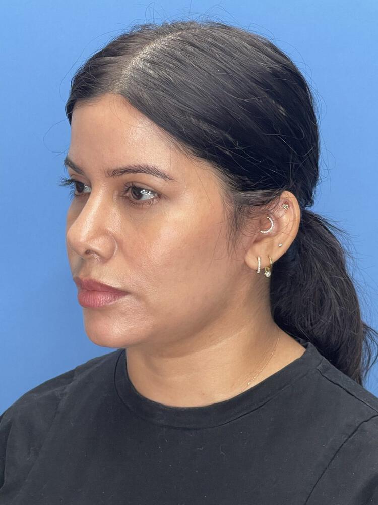 Mini Facelift Before & After Image