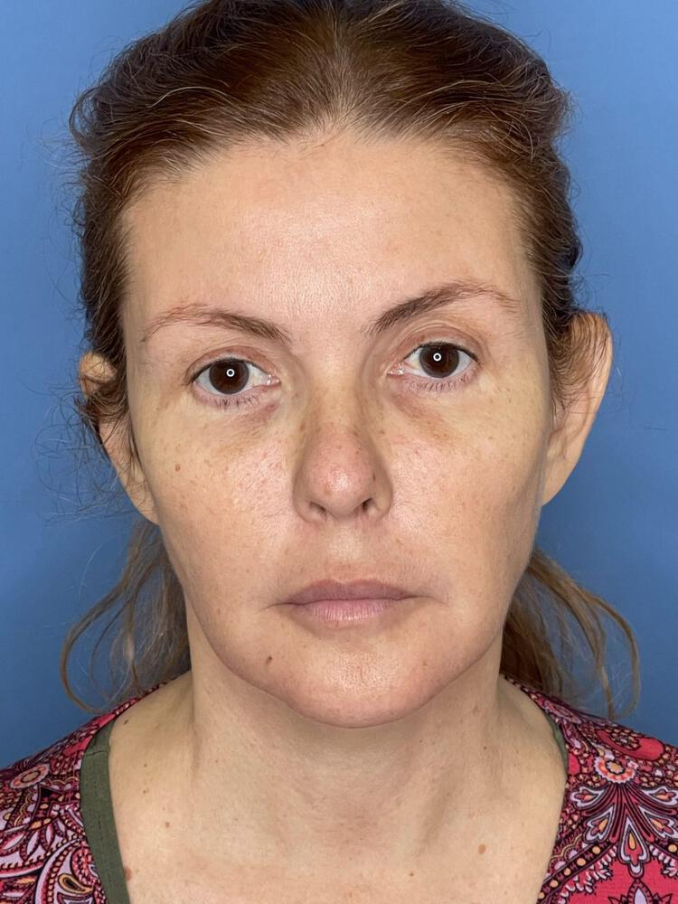 Mini Facelift Before & After Image