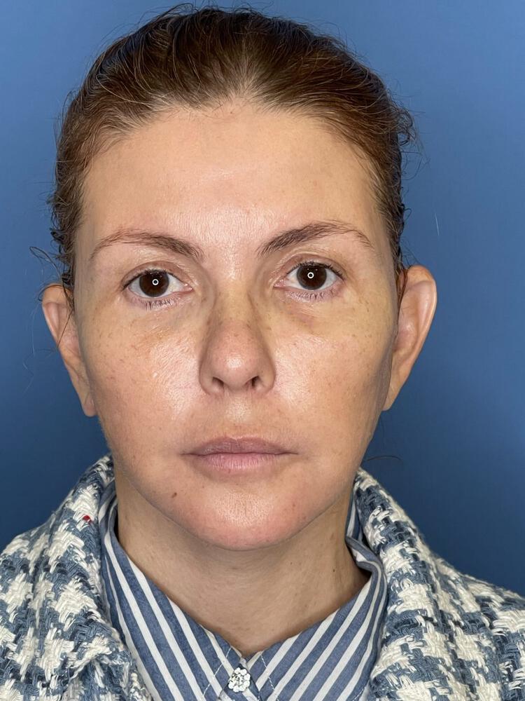 Mini Facelift Before & After Image