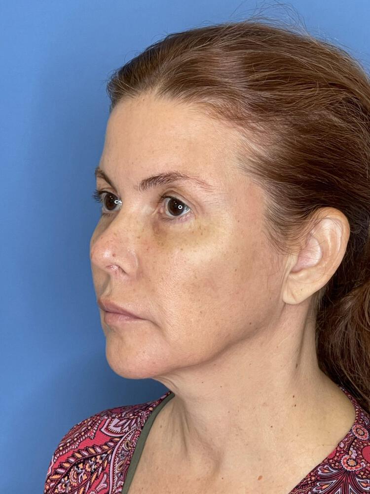 Mini Facelift Before & After Image