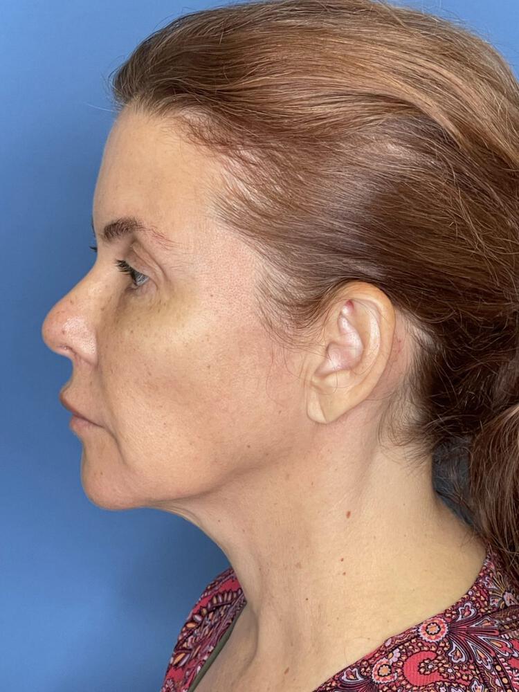 Mini Facelift Before & After Image