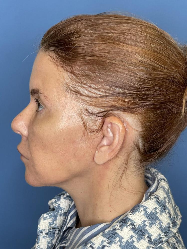 Mini Facelift Before & After Image