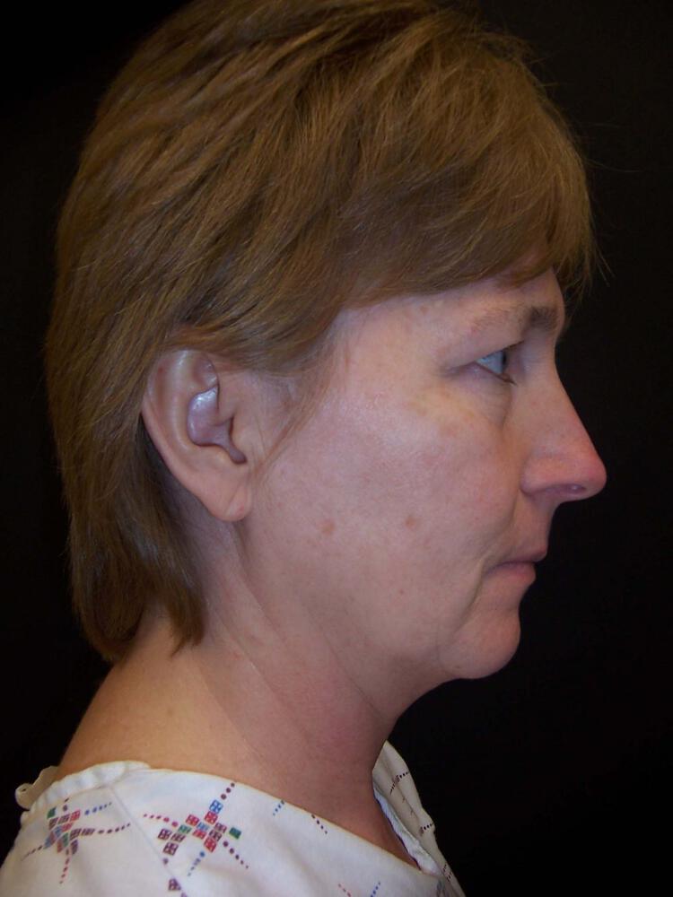 Mini Facelift Before & After Image