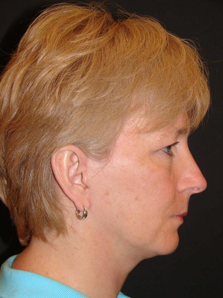 Mini Facelift Before & After Image