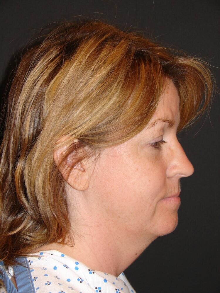 Neck Lift Before & After Image