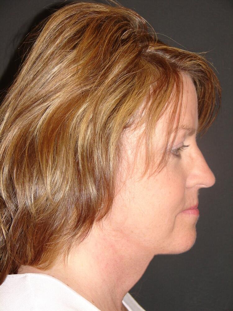 Neck Lift Before & After Image