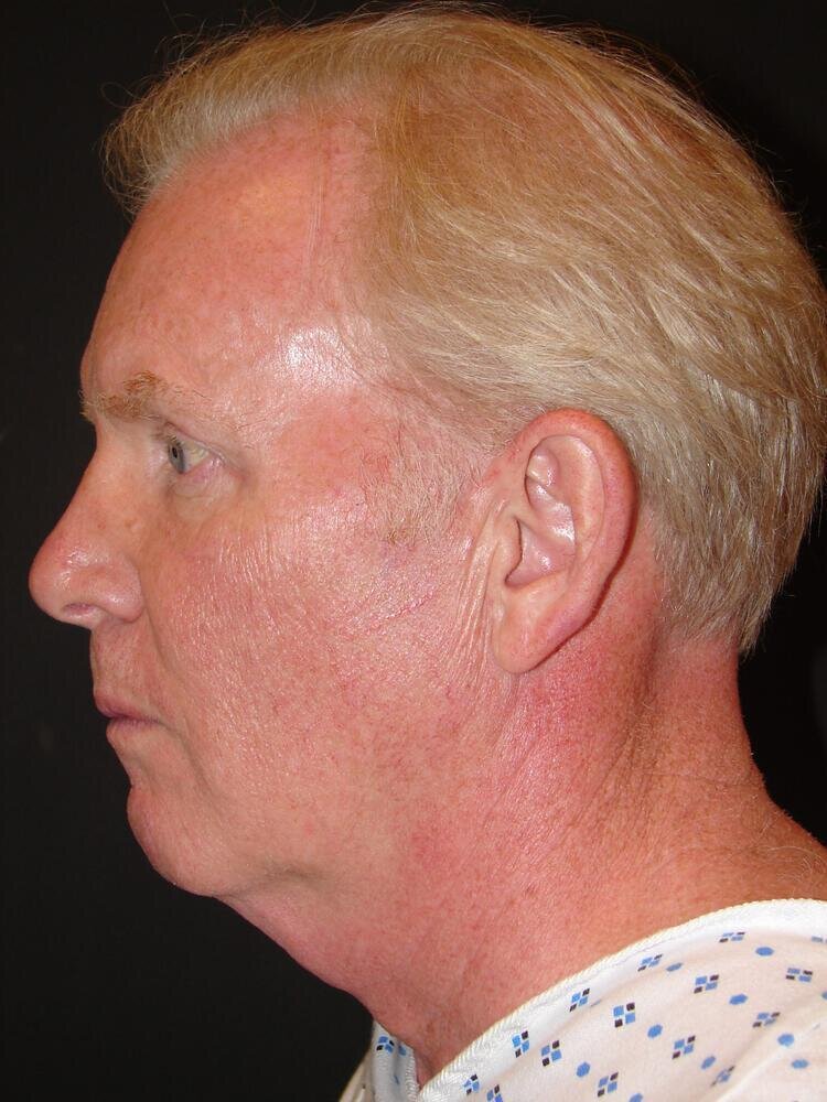 Neck Lift Before & After Image