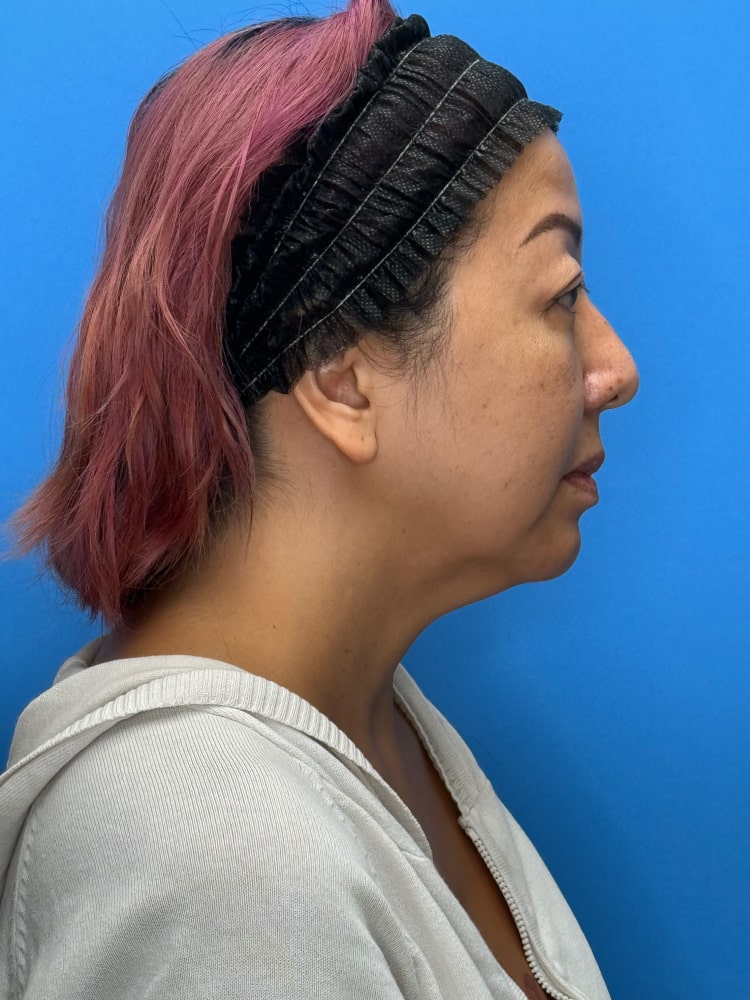 Neck Lift Before & After Image