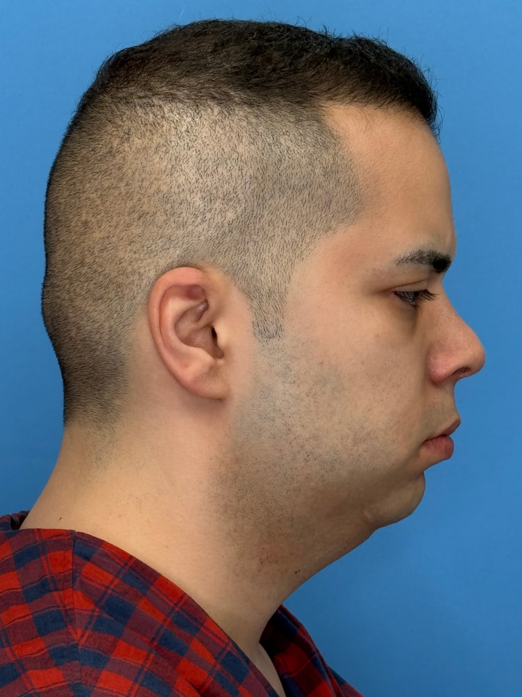 Neck Lift Before & After Image