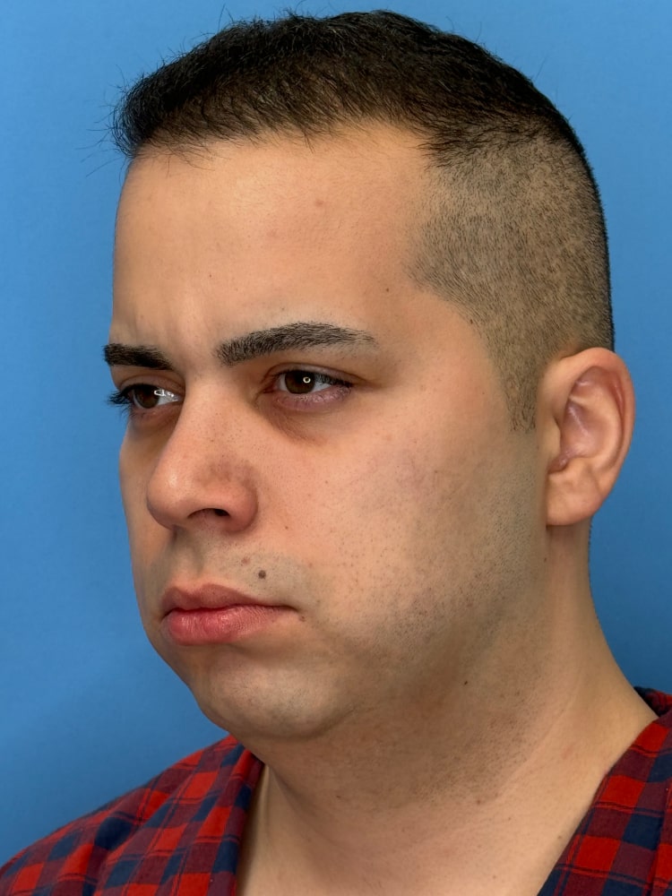 Neck Lift Before & After Image