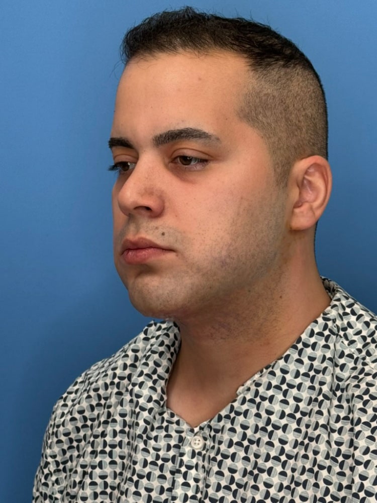 Neck Lift Before & After Image