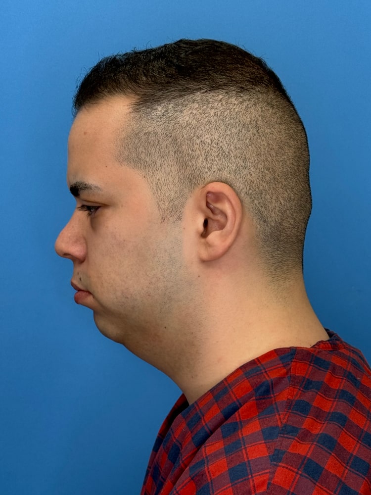 Neck Lift Before & After Image