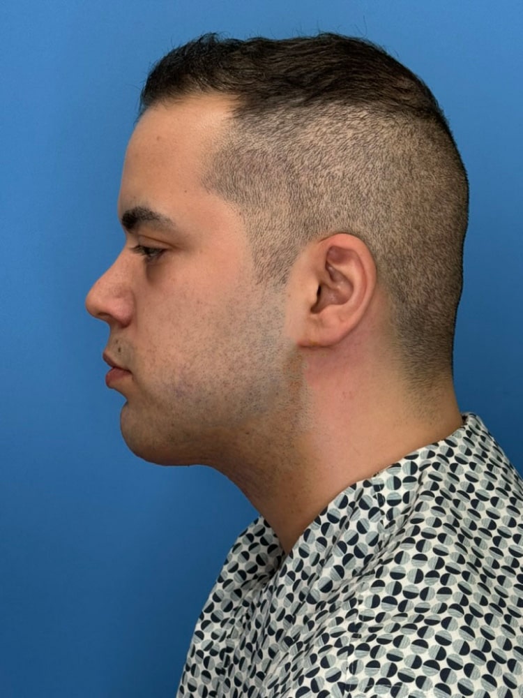 Neck Lift Before & After Image