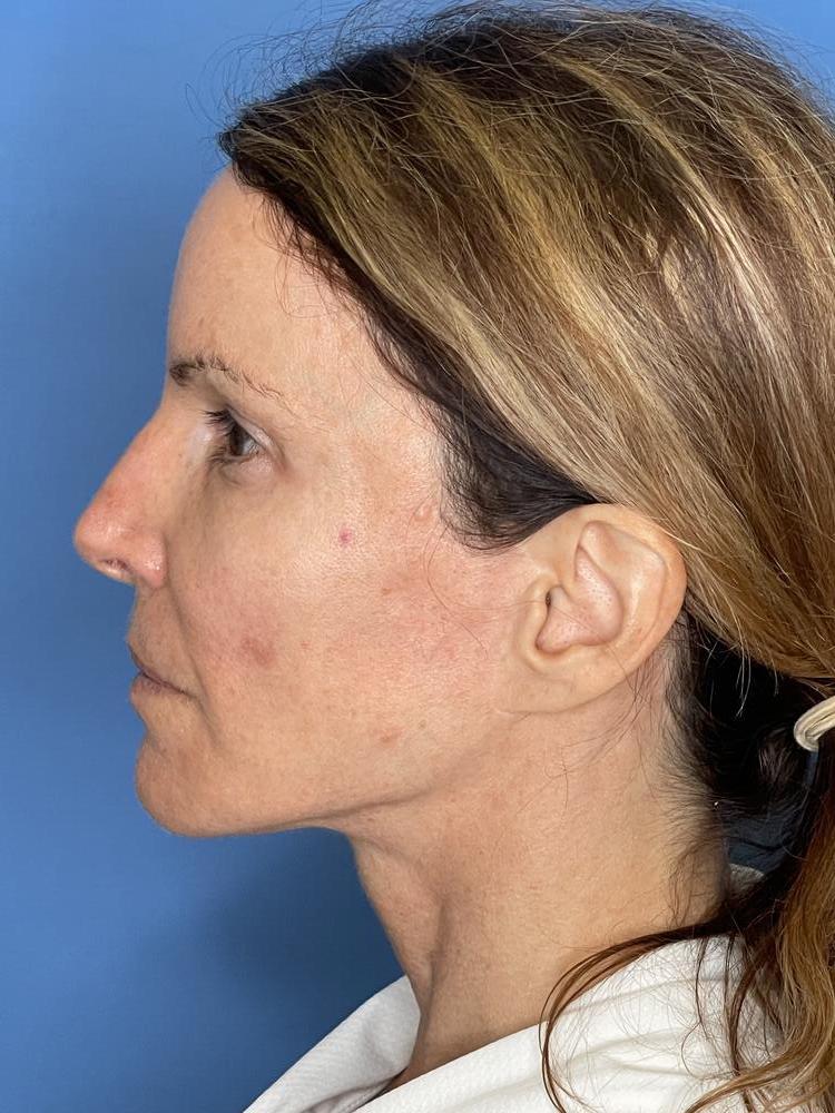 Revision Facelift Before & After Image