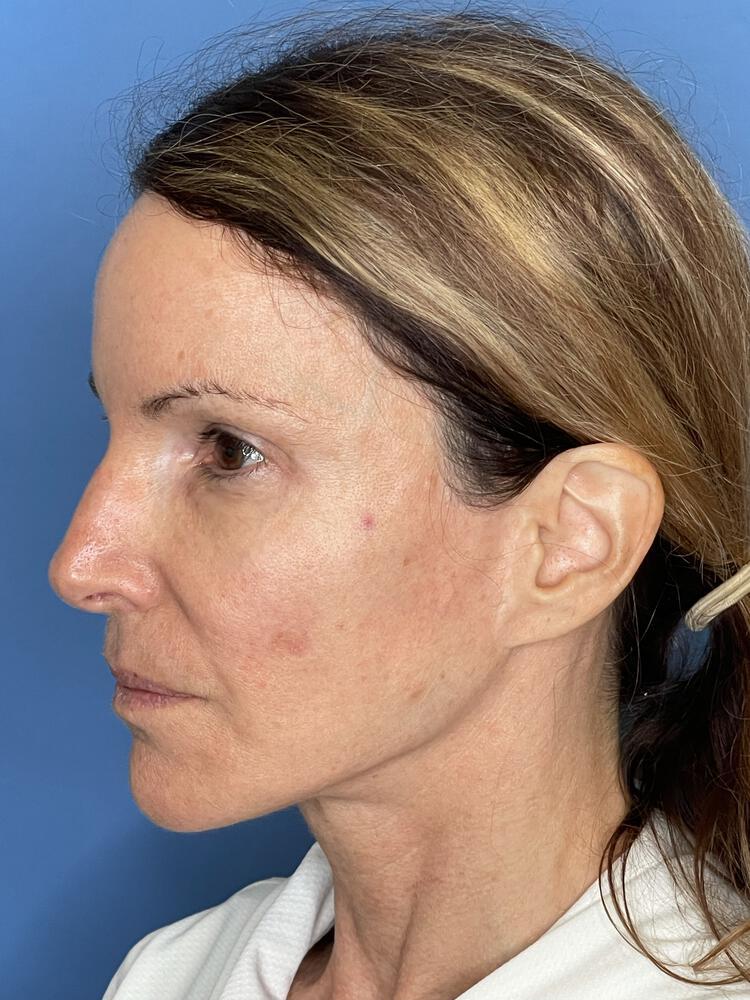 Revision Facelift Before & After Image