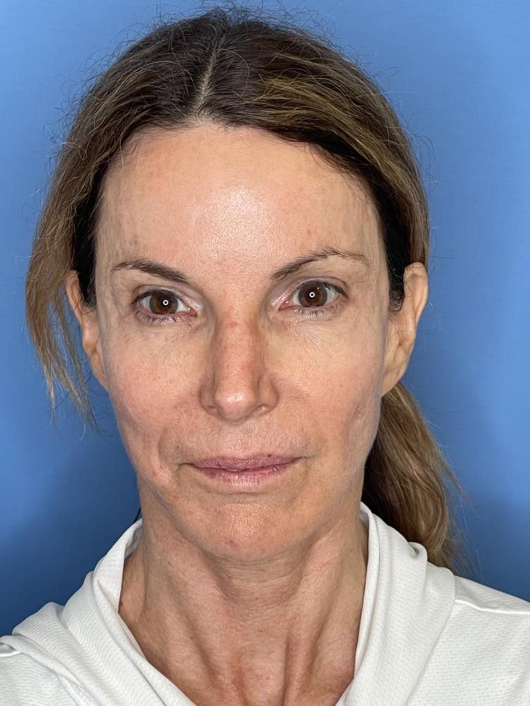 Revision Facelift Before & After Image