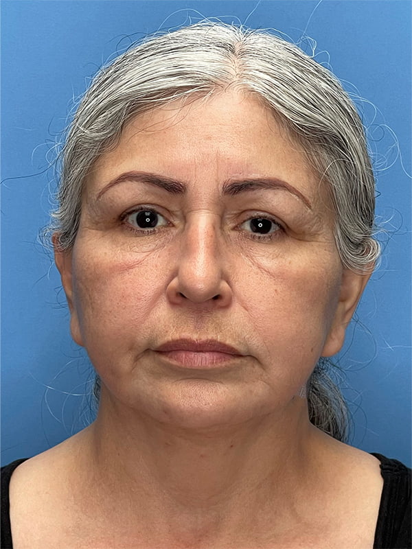 Revision Facelift Before & After Image