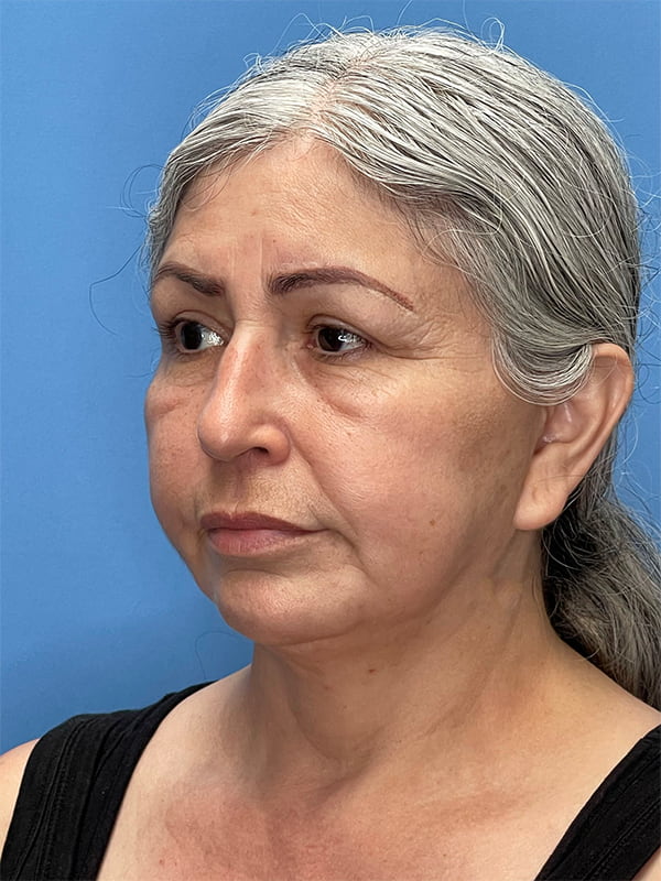 Revision Facelift Before & After Image