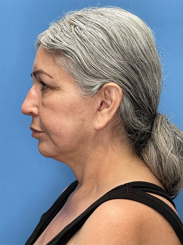 Revision Facelift Before & After Image