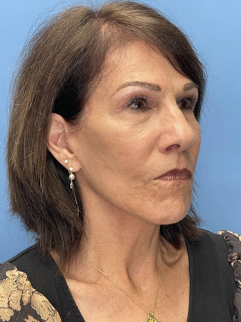 Revision Facelift Before & After Image