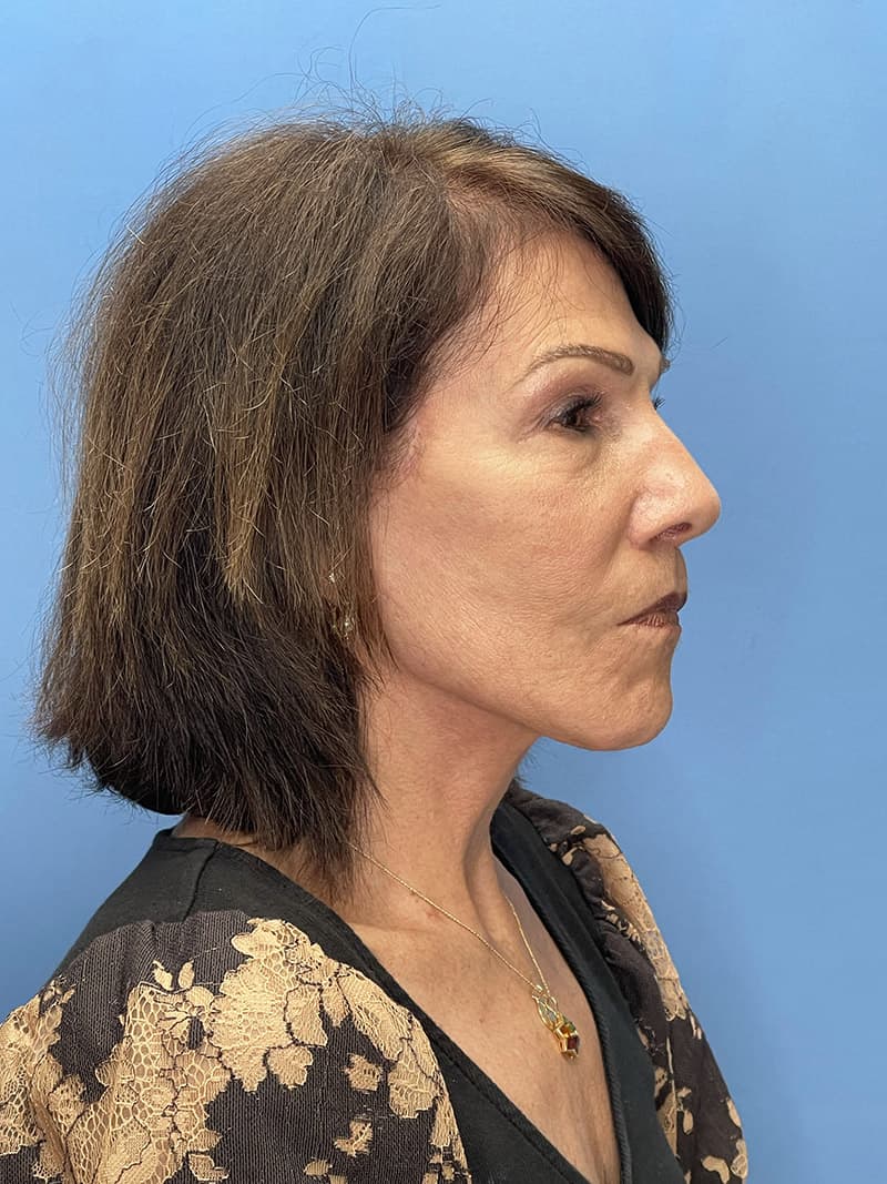 Revision Facelift Before & After Image