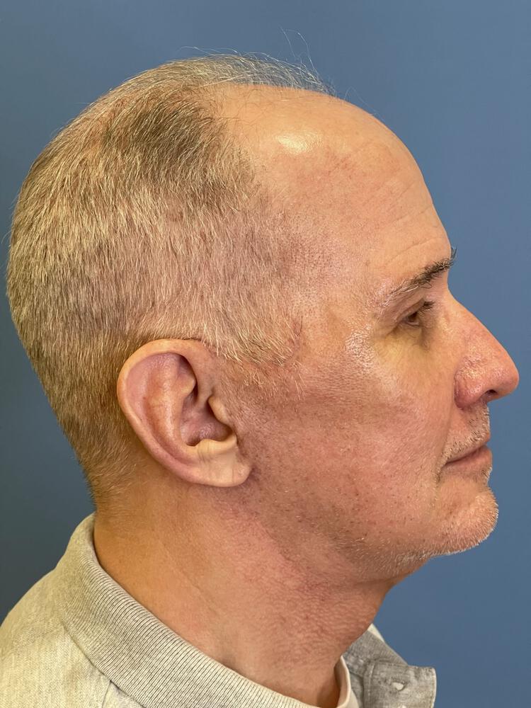 Cheek Implants Before & After Image