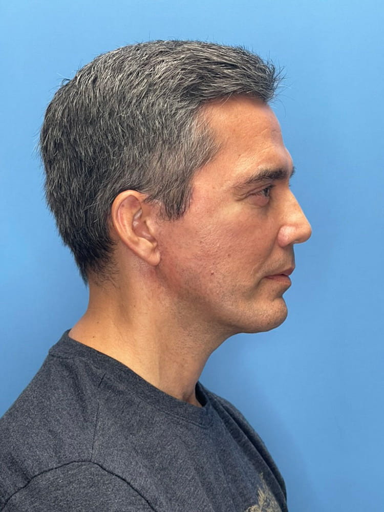 Cheek Implants Before & After Image