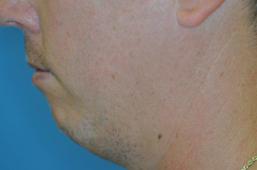 Chin Implants Before & After Image