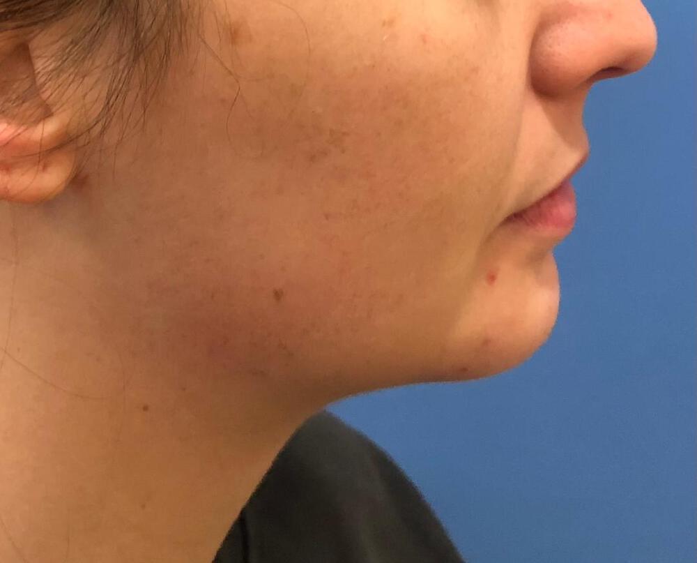 Chin Implants Before & After Image