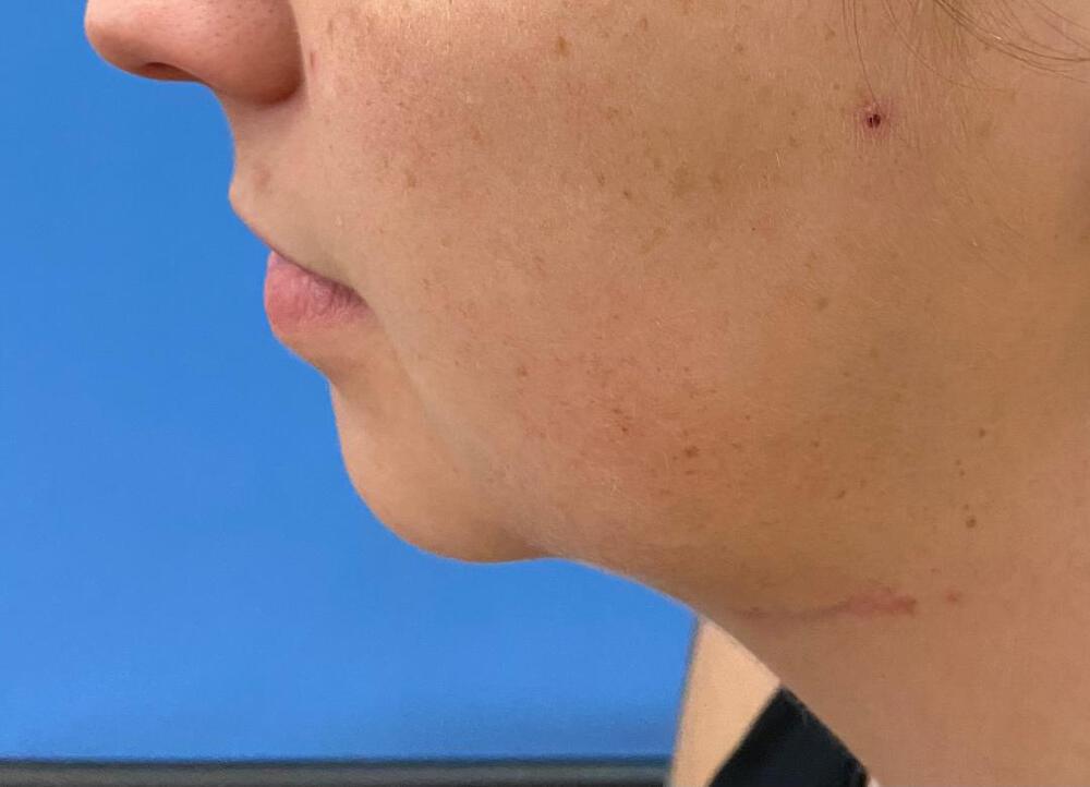 Chin Implants Before & After Image