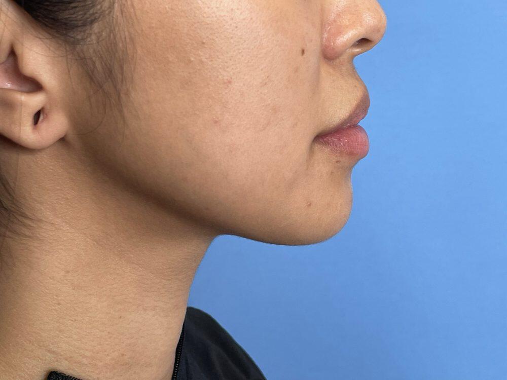 Chin Implants Before & After Image