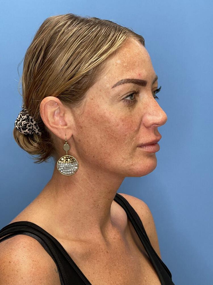 Chin Implants Before & After Image