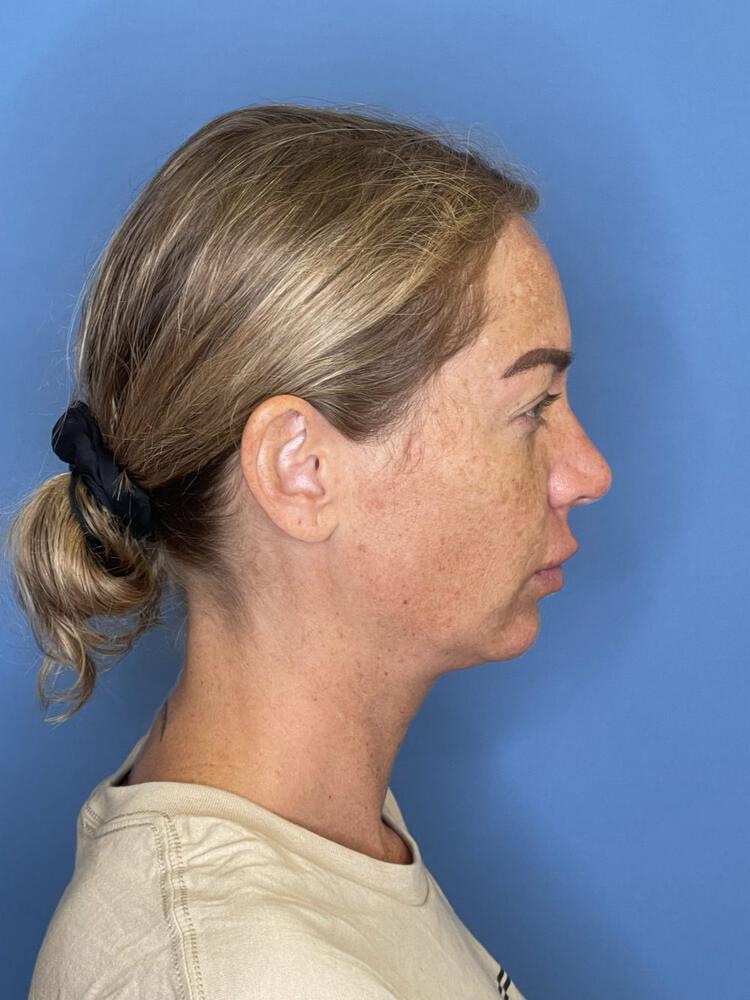 Chin Implants Before & After Image