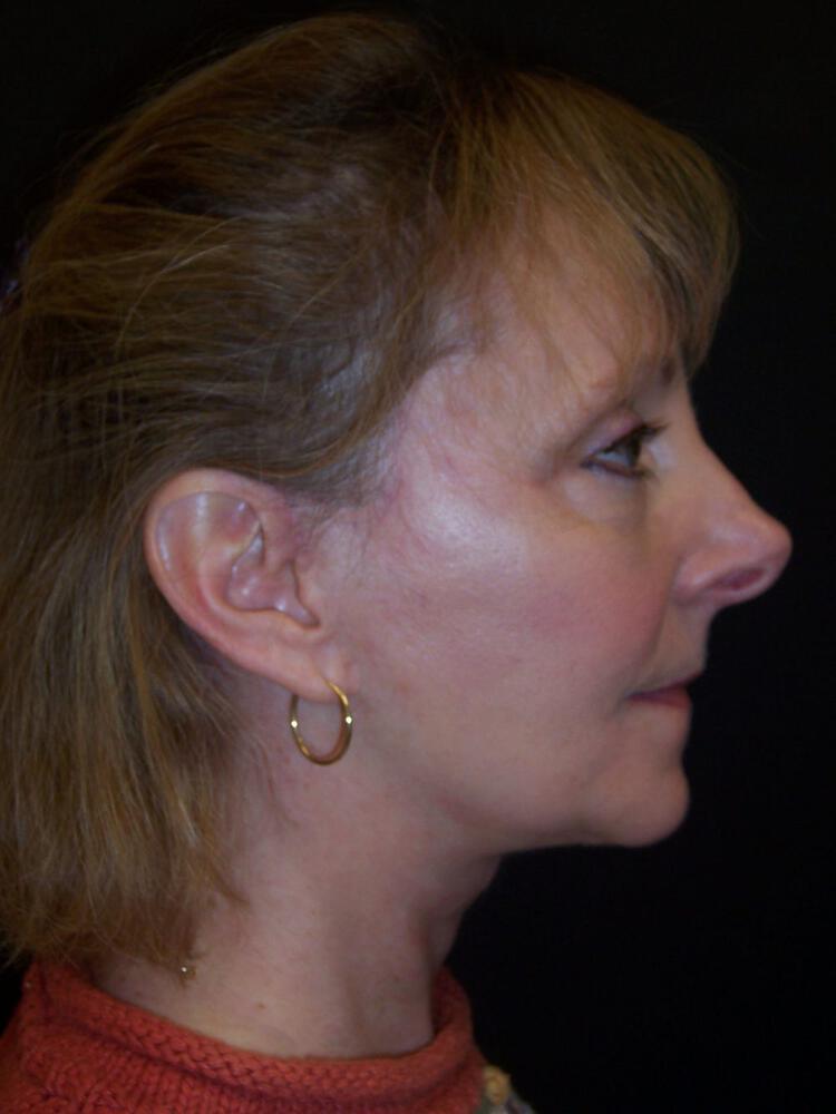 Chin Implants Before & After Image