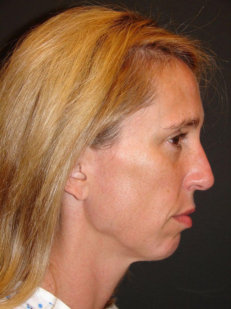 Chin Implants Before & After Image