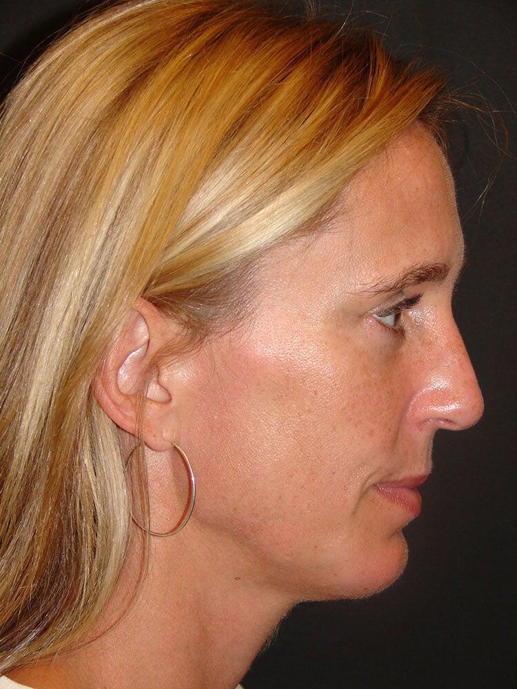 Chin Implants Before & After Image