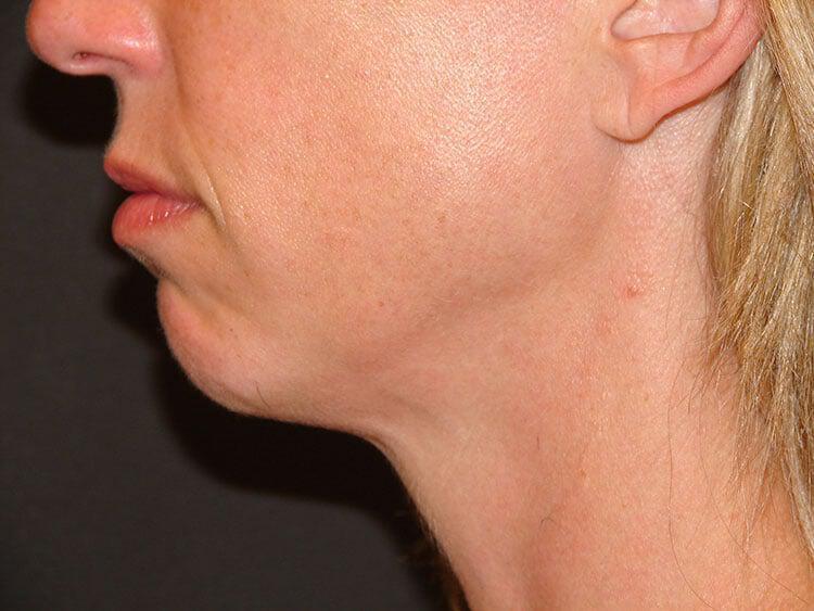 Chin Implants Before & After Image