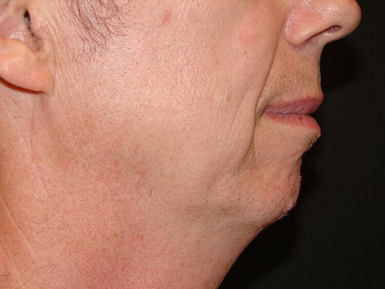 Chin Implants Before & After Image