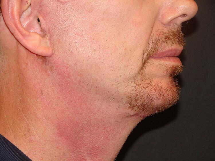 Chin Implants Before & After Image