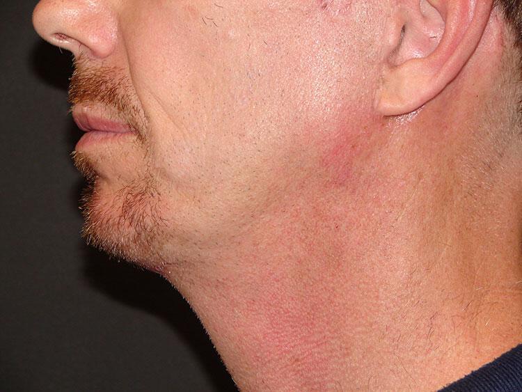 Chin Implants Before & After Image