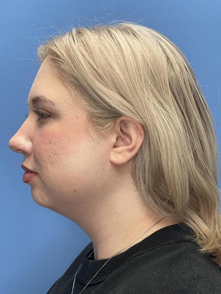 Chin Implants Before & After Image