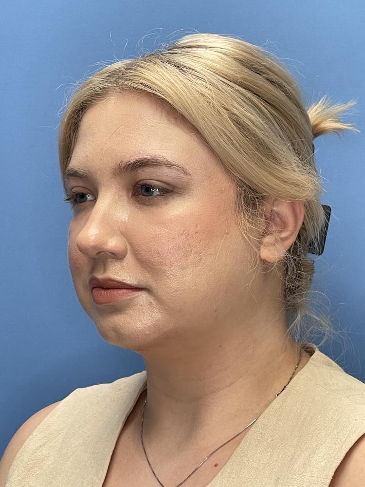 Chin Implants Before & After Image