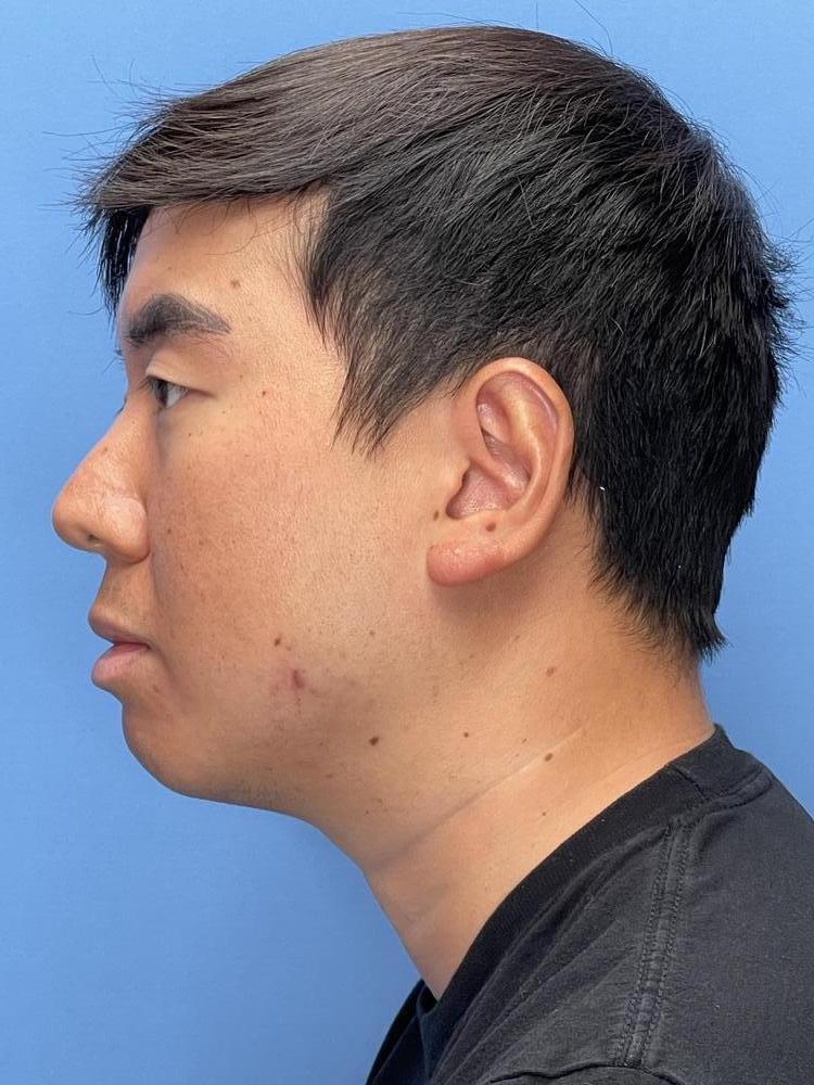 Chin Implants Before & After Image