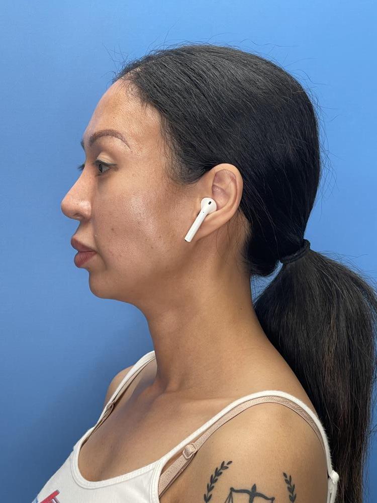 Chin Implants Before & After Image