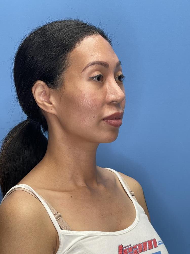 Chin Implants Before & After Image