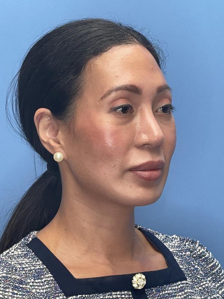 Chin Implants Before & After Image