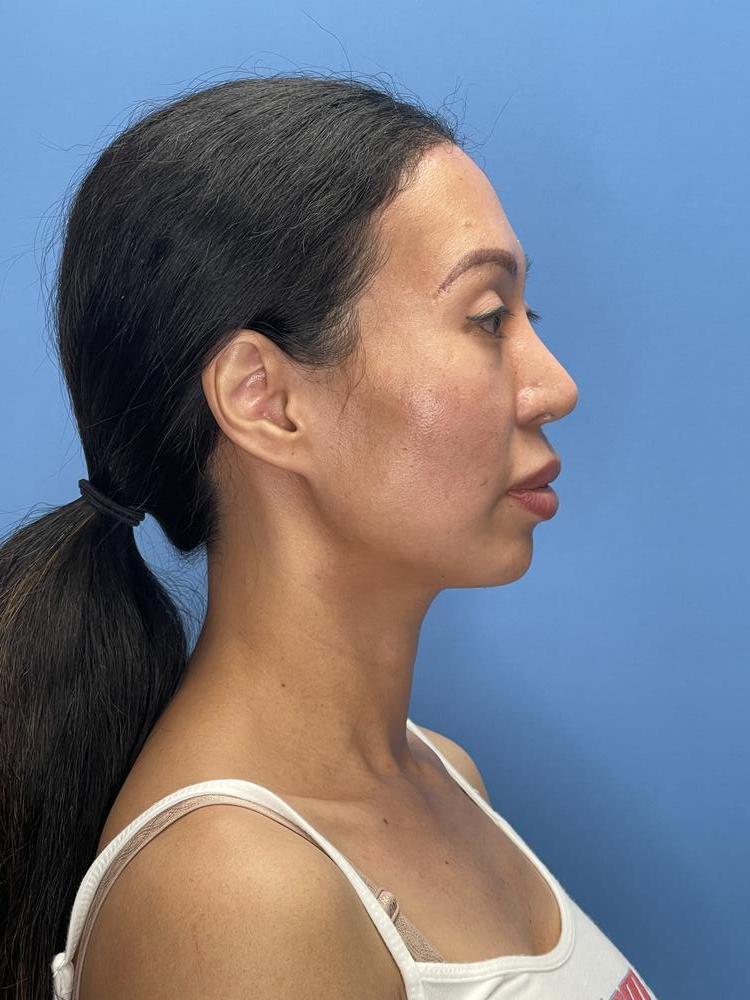 Chin Implants Before & After Image