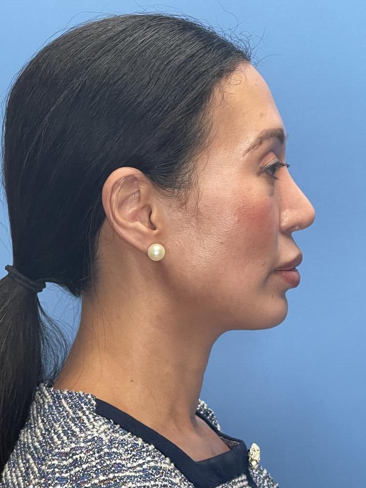 Chin Implants Before & After Image