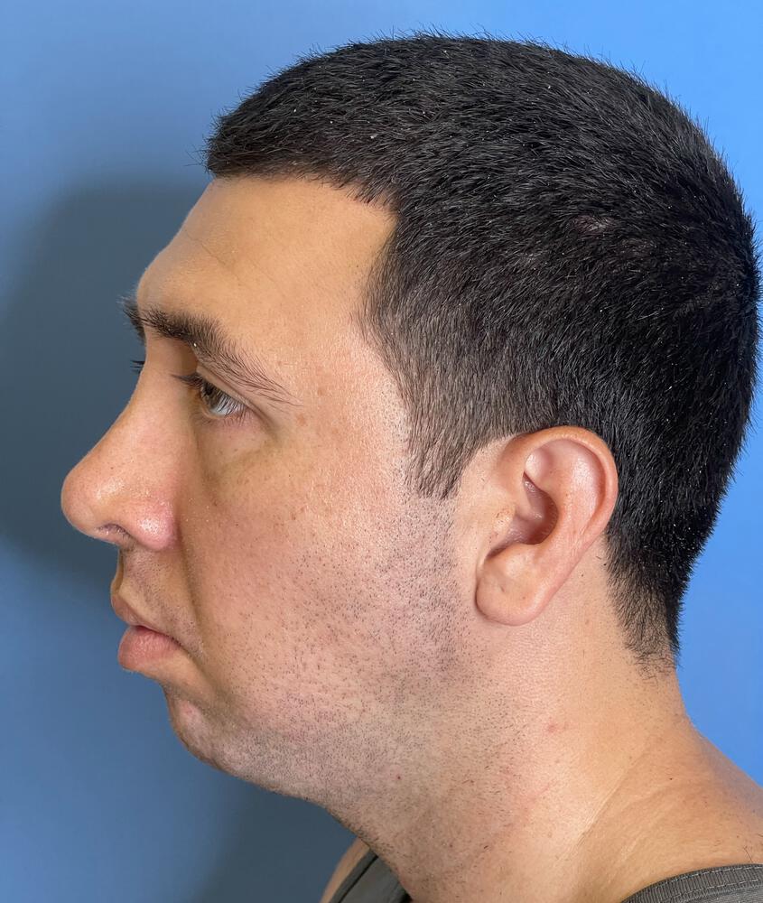 Chin Implants Before & After Image