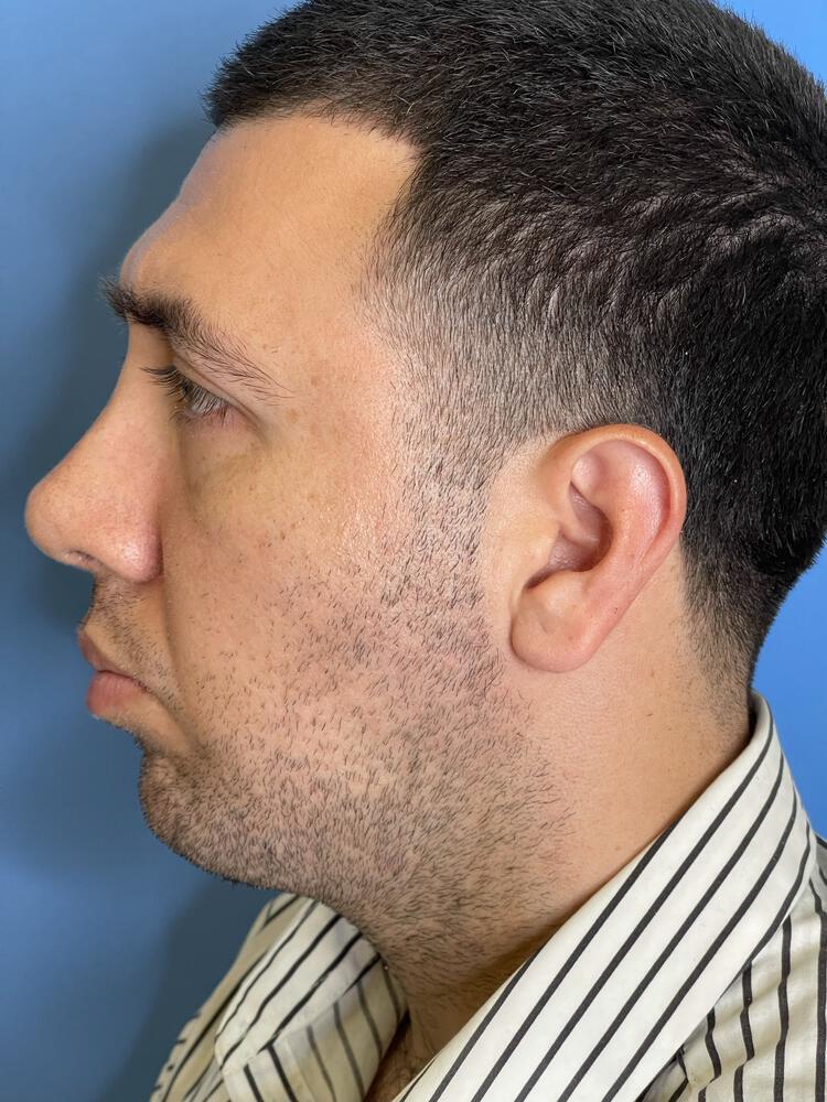 Chin Implants Before & After Image